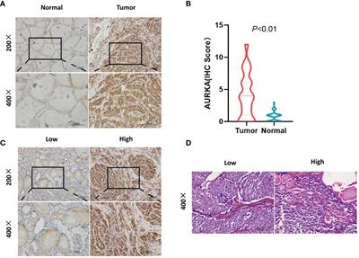 Predictive and prognostic value of aurora kinase A combined with tumor-infiltrating lymphocytes in medullary thyroid carcinoma